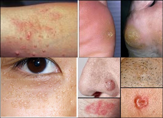 điều trị mụn hạt cơm - hình minh họa 2