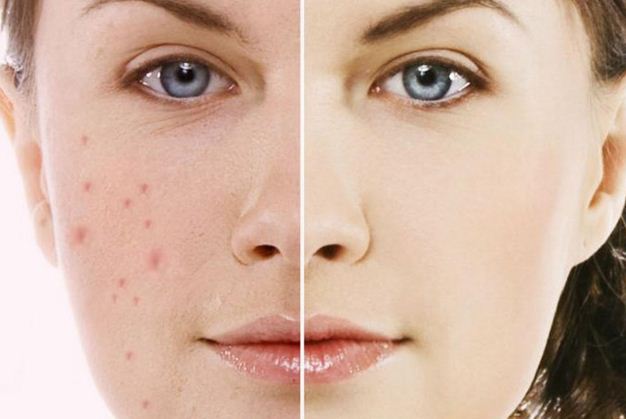 cách trị vết thâm hiệu quả