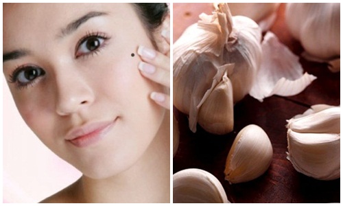 tẩy nốt ruồi